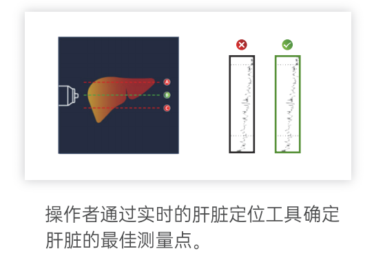 看见新力量|国产FibroScan® Pro无创肝病检测仪成医疗健康新热门