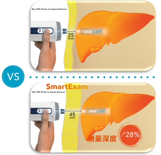 看见新力量|国产FibroScan® Pro无创肝病检测仪成医疗健康新热门