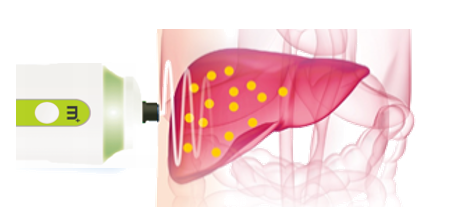 FibroScan® 无创肝脏检测是什么？