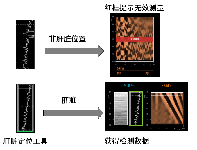 FibroScan® 无创肝脏检测是什么？